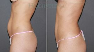Tummy Tuck Patient