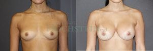 Breast Augmentation Patient