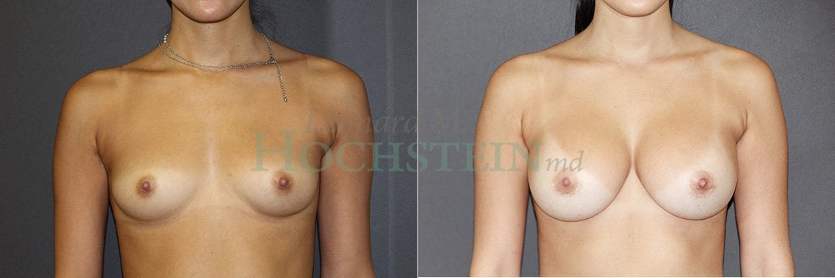 Breast Augmentation Patient