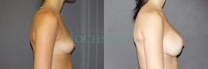 Breast Augmentation Patient