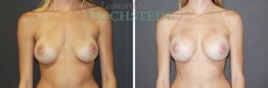 Breast Revision Patient