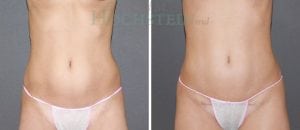 Tummy Tuck Patient