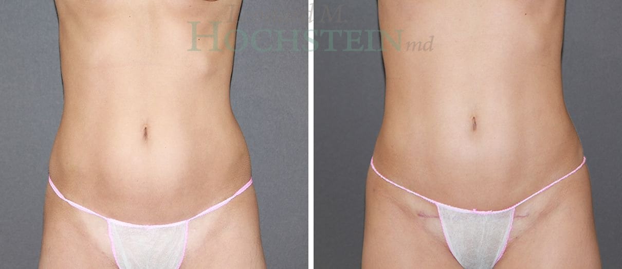 Tummy Tuck Patient