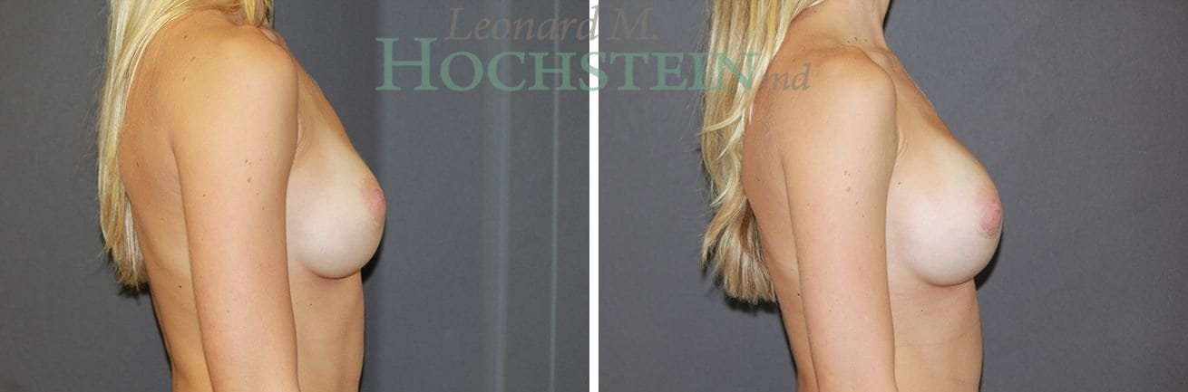 Breast Revision Patient