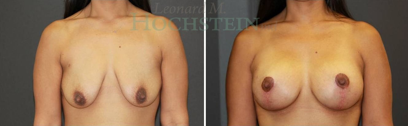 Breast Lift With Implants Patient