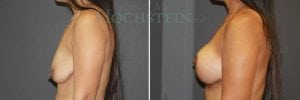 Breast Lift With Implants Patient