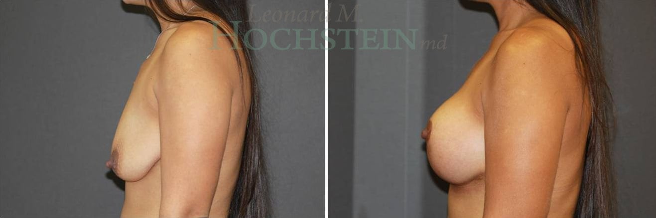 Breast Lift With Implants Patient