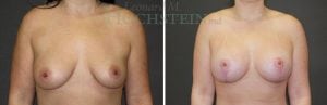 Breast Lift With Implants Patient