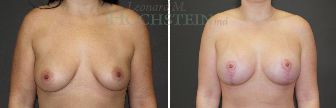 Breast Lift With Implants Patient