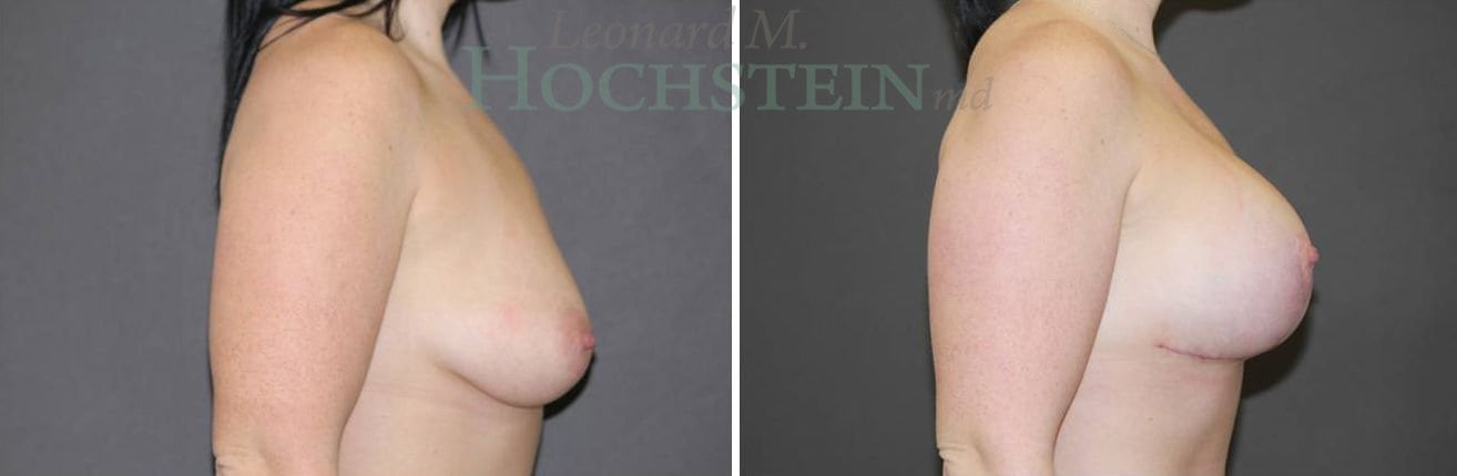 Breast Lift With Implants Patient