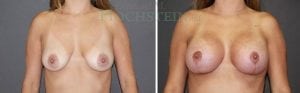Breast Lift With Implants Patient