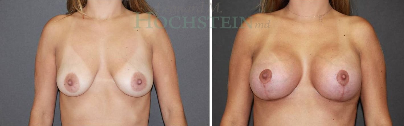 Breast Lift With Implants Patient