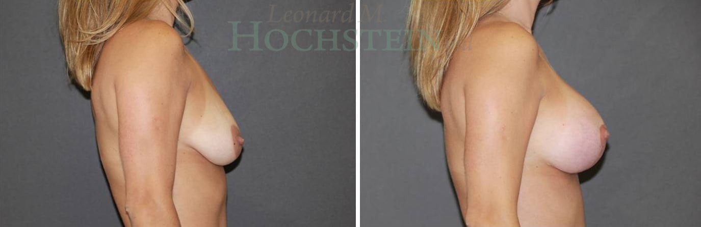 Breast Lift With Implants Patient