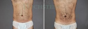 Liposuction Patient 33
