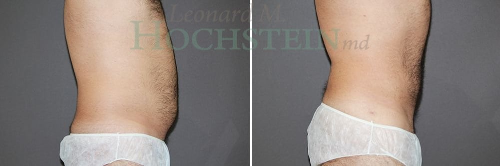 Liposuction Patient
