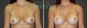 Breast Lift With Implants Patient