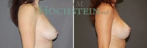 Breast Lift With Implants Patient