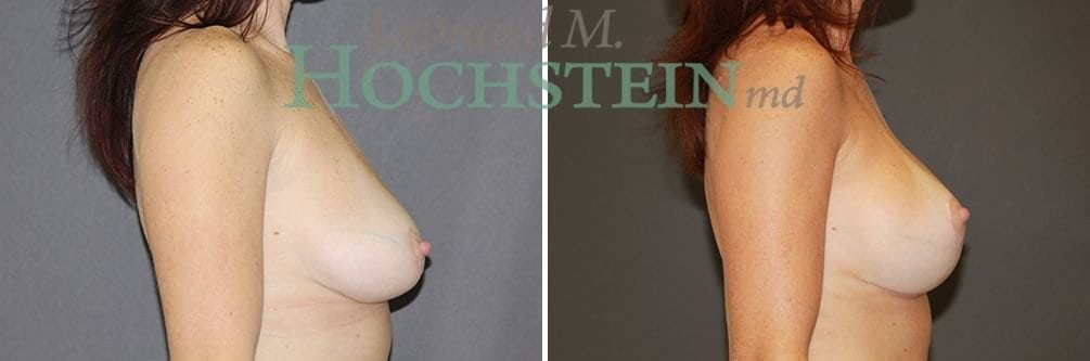 Breast Lift With Implants Patient