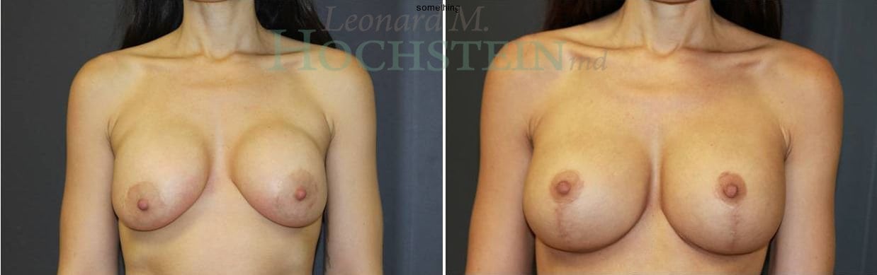 Breast Lift With Implants Patient
