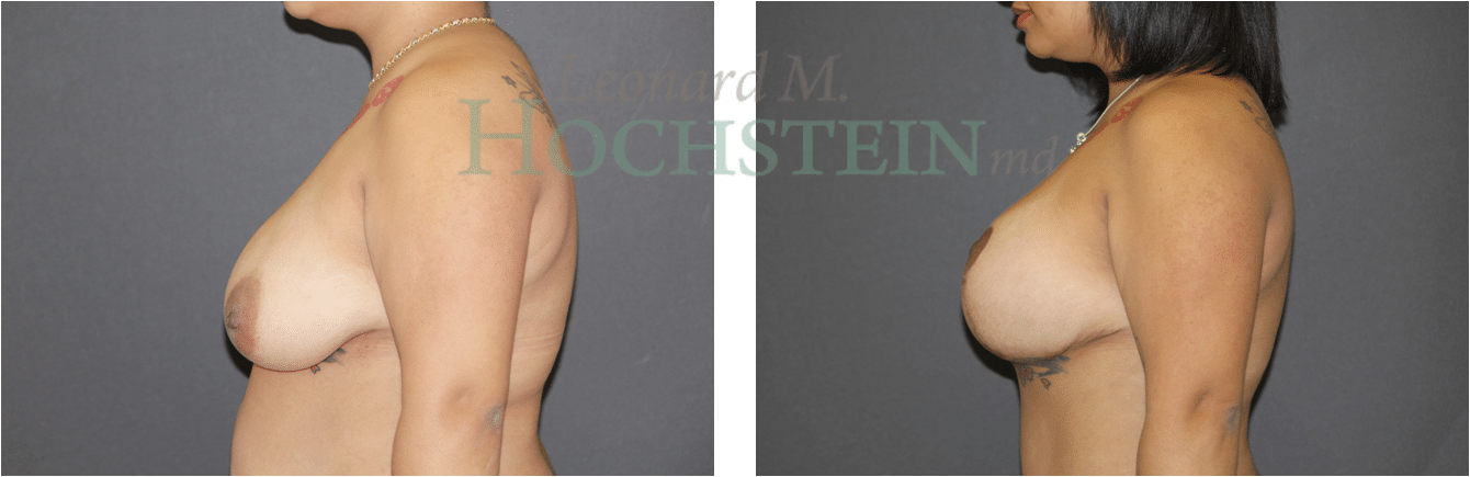 Breast Lift With Implants Patient