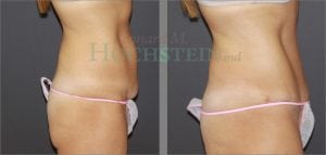 Tummy Tuck Patient