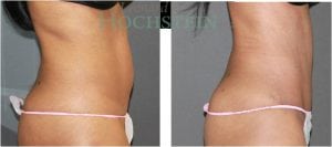 Tummy Tuck Patient 15