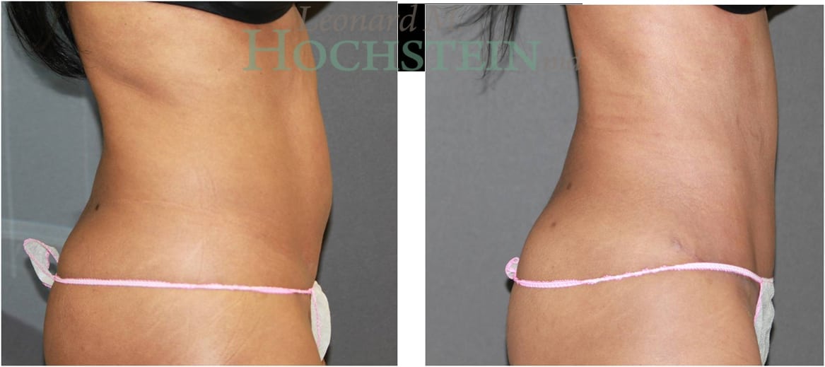 Tummy Tuck Patient