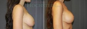 Breast Lift With Implants Patient