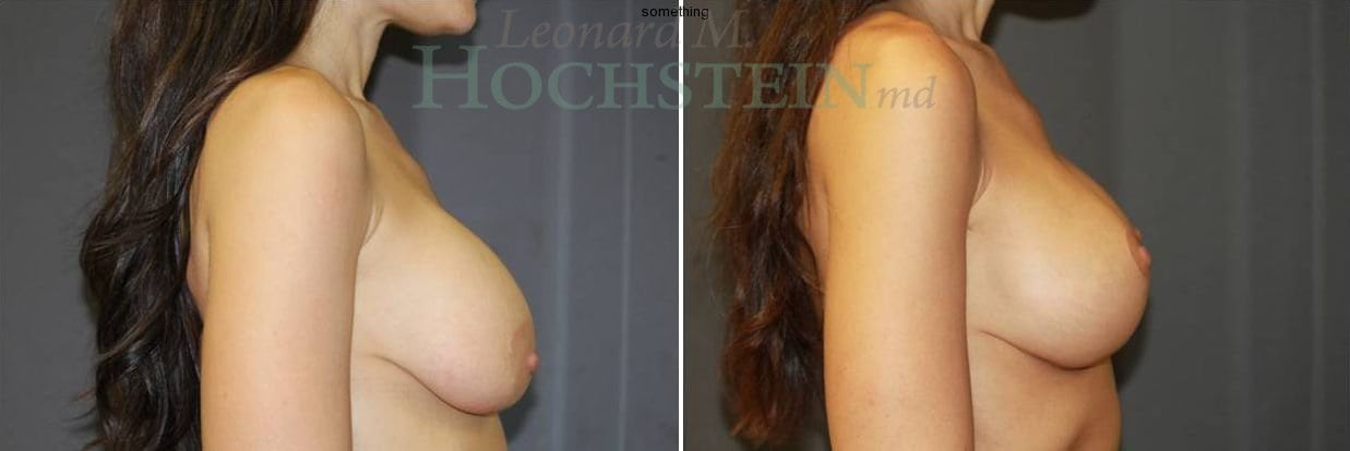 Breast Lift With Implants Patient