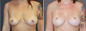 Breast Lift Patient 155