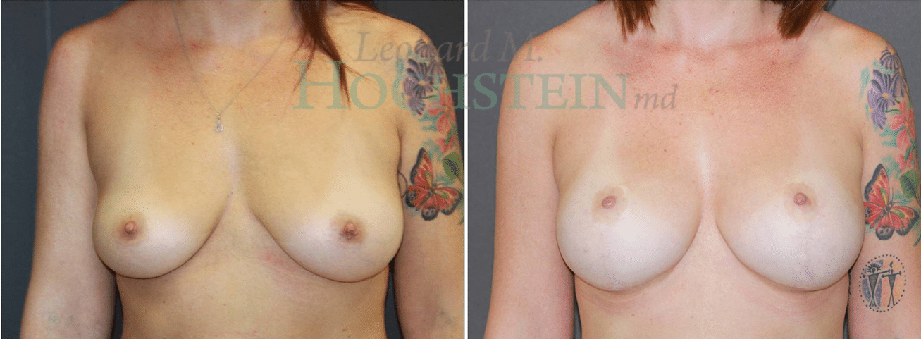 Breast Lift With Implants Patient