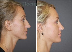 Rhinoplasty Patient