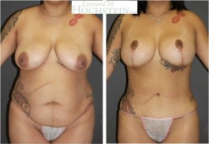 Mommy Makeover Patient