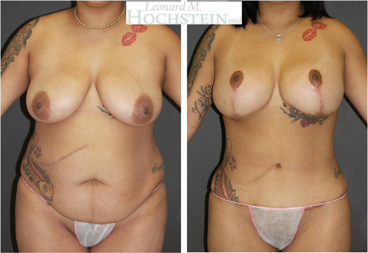 Mommy Makeover Patient