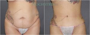 Tummy Tuck Patient 12