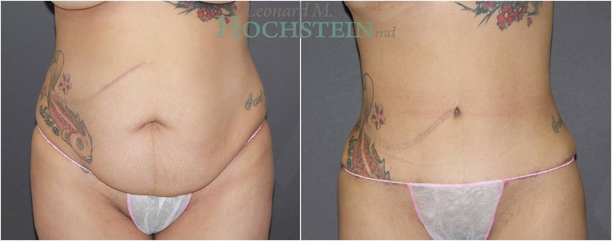 Tummy Tuck Patient