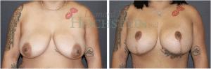 Breast Lift With Implants Patient