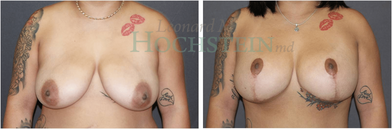 Breast Lift With Implants Patient
