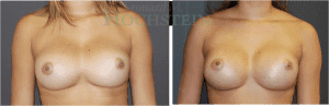 Breast Revision Patient 60