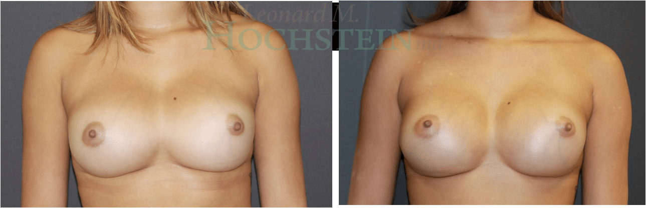 Breast Revision Patient