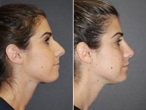 Rhinoplasty Patient