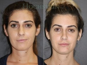 Rhinoplasty Patient