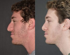 Rhinoplasty Patient 65