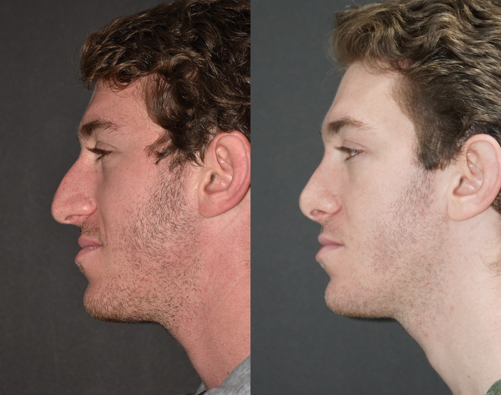 Rhinoplasty Patient