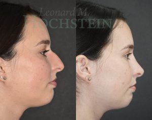 Rhinoplasty Patient 66