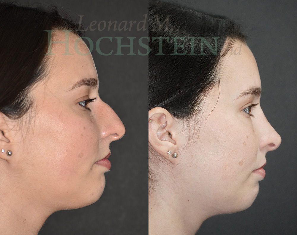 Rhinoplasty Patient
