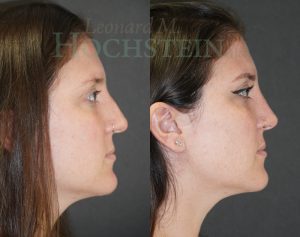 Rhinoplasty Patient