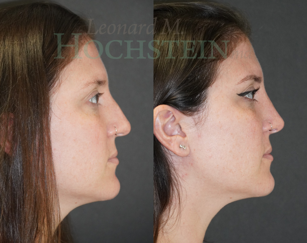 Rhinoplasty Patient