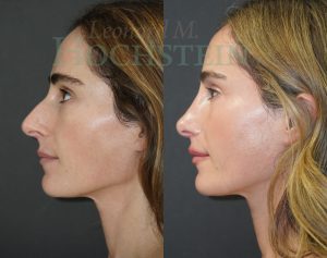 Rhinoplasty Patient 68