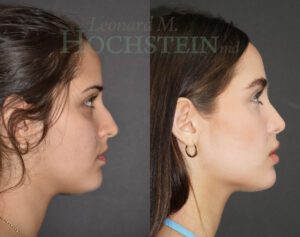 Rhinoplasty Patient